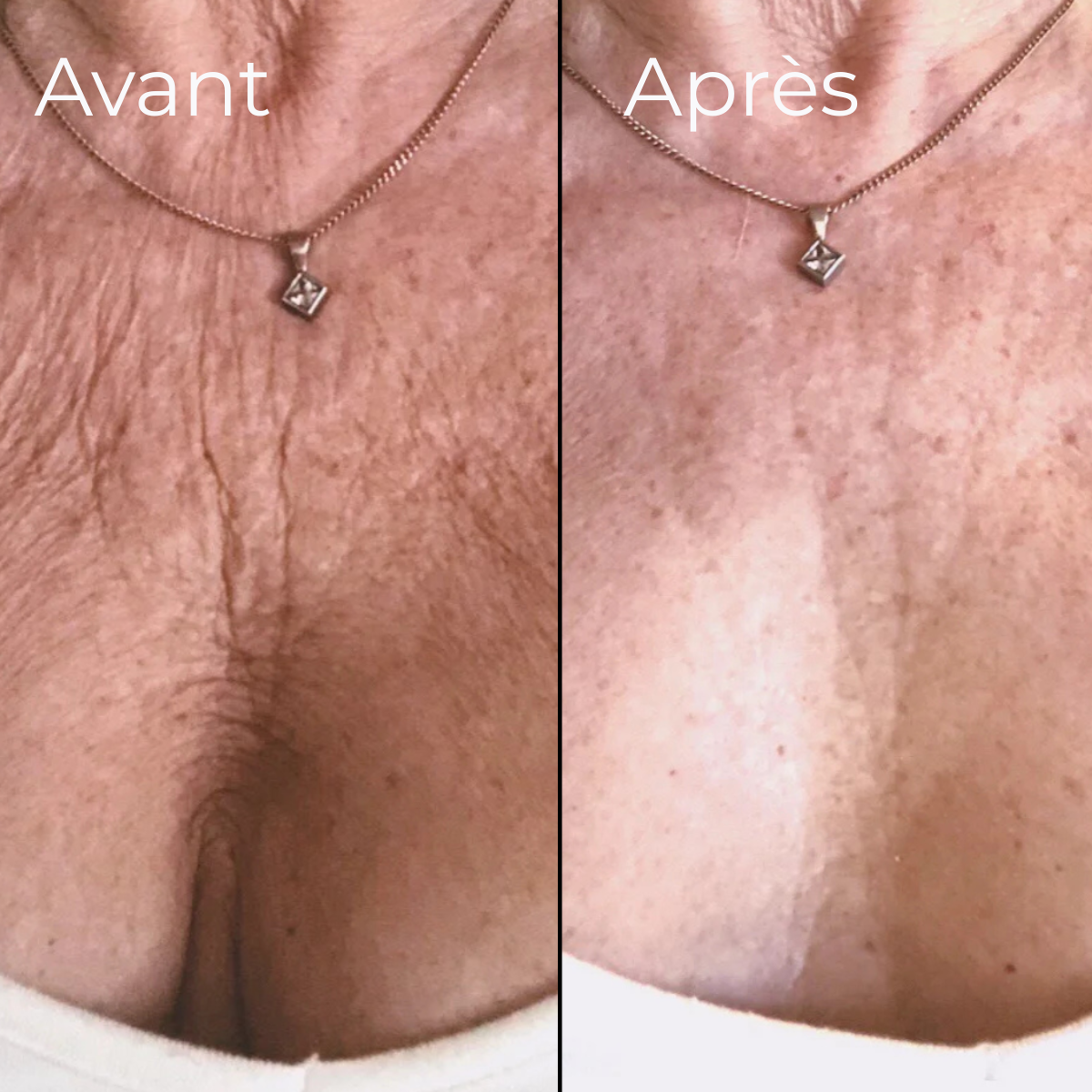Expert LED cou & décolleté HARMONYS