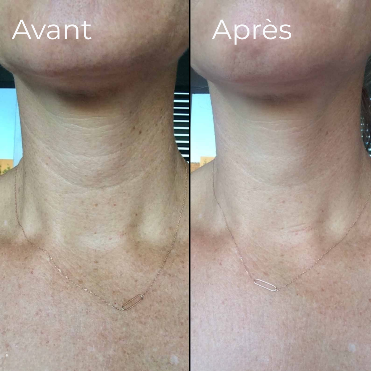 Expert LED cou & décolleté HARMONYS