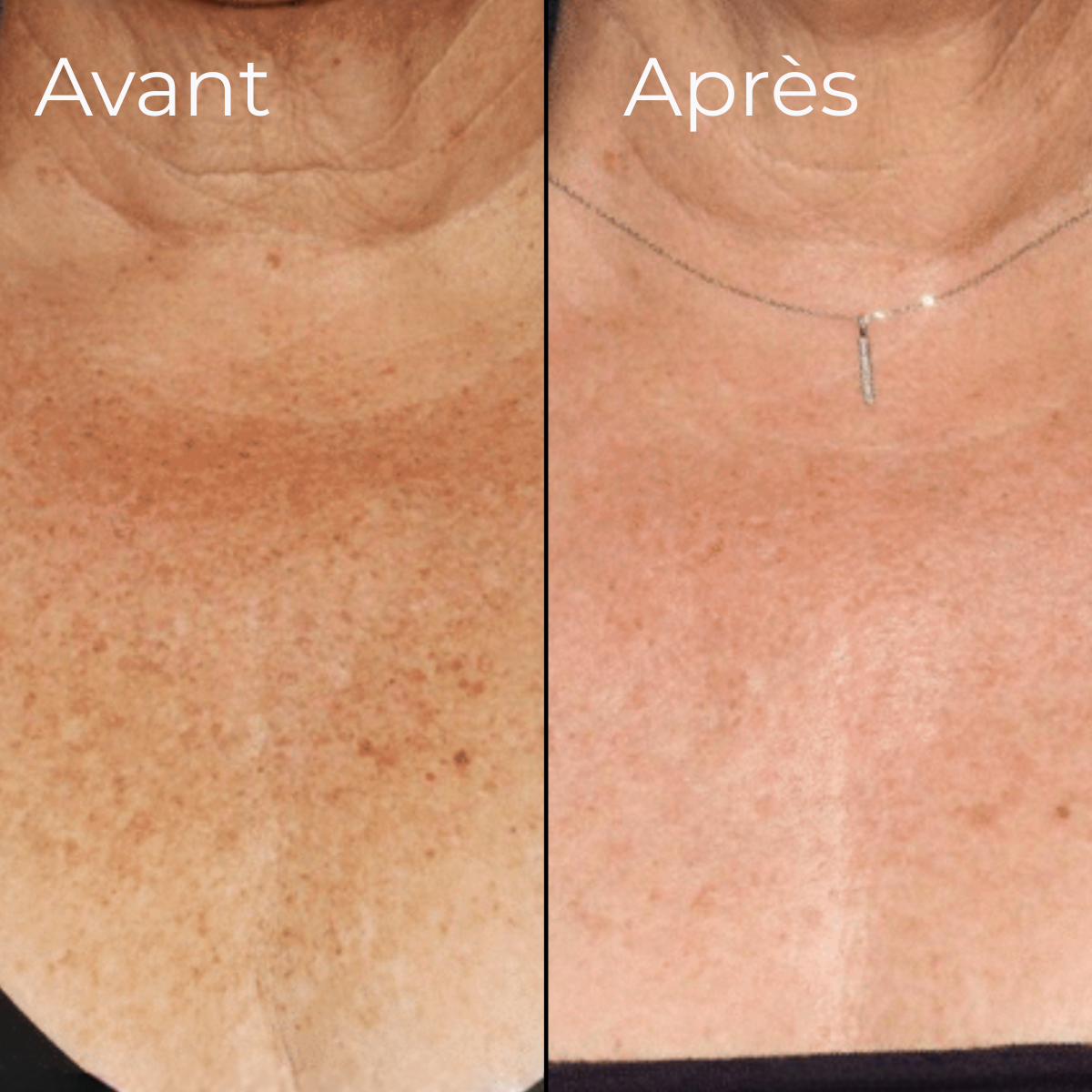 Expert LED cou & décolleté HARMONYS